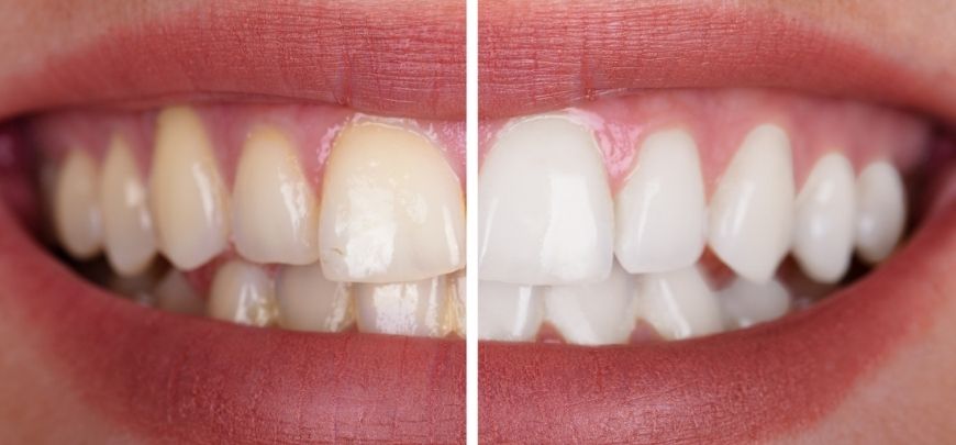 blanqueamiento dental en el meta